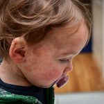 A toddler boy with a red measles rash on his face.